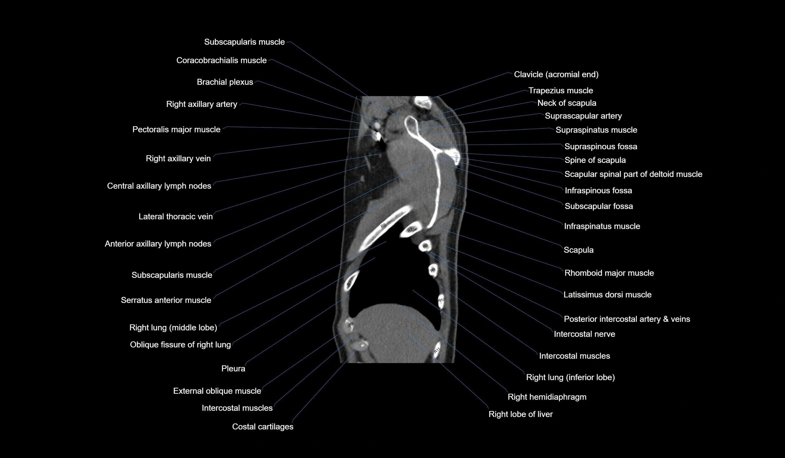 CT chest (thorax) soft tissue window labelled sagittal cross sectional anatomy radiology image-00019.webp